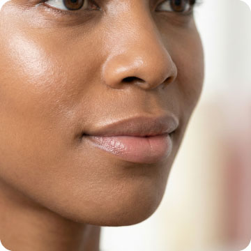 2 ml dermal filler for structure and support